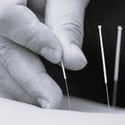 Acupunctuur